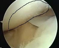 Injured Knee (Meniscus)