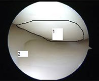 Normal Knee (Meniscus)